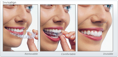 invisalign-auckland-treatment-dental.jpg